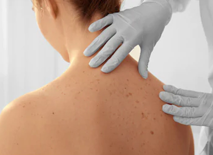Skin Cancer Resection