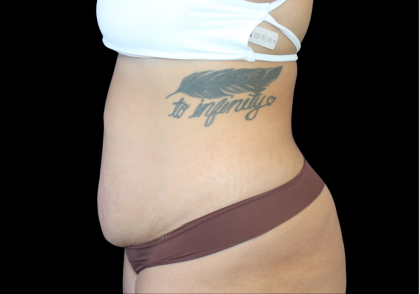Liposuction Before & After Patient #424