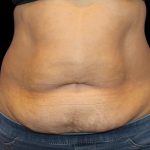Liposuction Before & After Patient #425