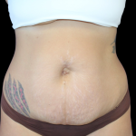 Liposuction Before & After Patient #424