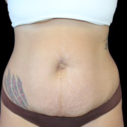 Liposuction Before & After Patient #424