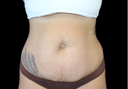 Liposuction Before & After Patient #424