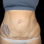 Liposuction Before & After Patient #424