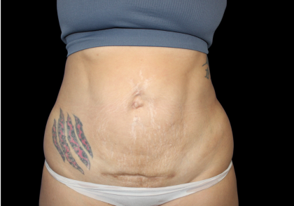 Liposuction Before & After Patient #424