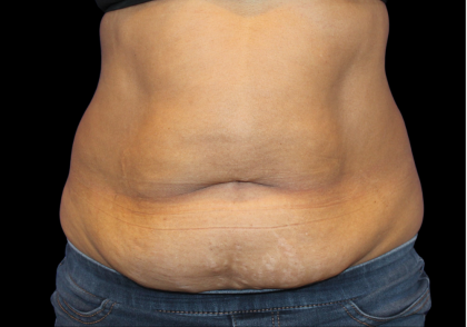 Liposuction Before & After Patient #425