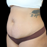 Liposuction Before & After Patient #424