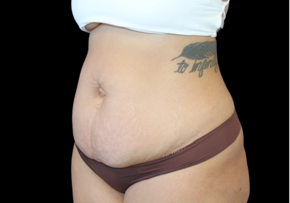 Liposuction Before & After Patient #424
