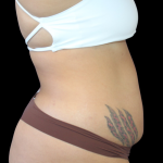 Liposuction Before & After Patient #424