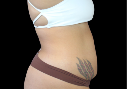 Liposuction Before & After Patient #424