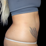 Liposuction Before & After Patient #424