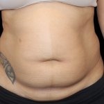 Liposuction Before & After Patient #426