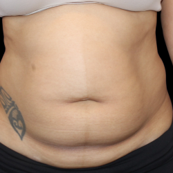Liposuction Before & After Patient #426