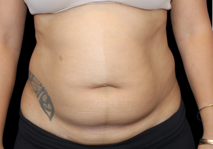 Liposuction Before & After Patient #426