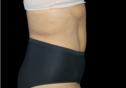 Liposuction Before & After Patient #425