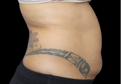 Liposuction Before & After Patient #426