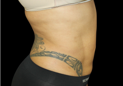Liposuction Before & After Patient #426