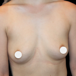 Breast Augmentation Before & After Patient #364