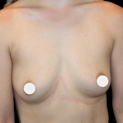 Breast Augmentation Before & After Patient #364