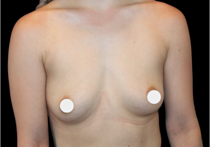 Breast Augmentation Before & After Patient #364