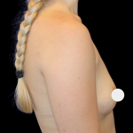Breast Augmentation Before & After Patient #364