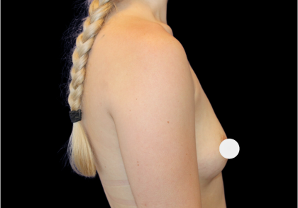 Breast Augmentation Before & After Patient #364