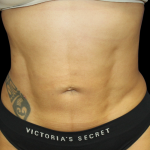Liposuction Before & After Patient #426