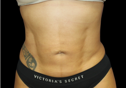 Liposuction Before & After Patient #426