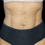 Liposuction Before & After Patient #425