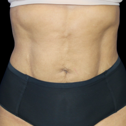 Liposuction Before & After Patient #425