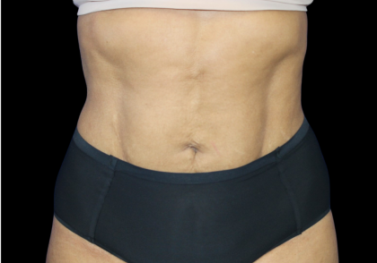 Liposuction Before & After Patient #425