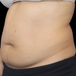 Liposuction Before & After Patient #426
