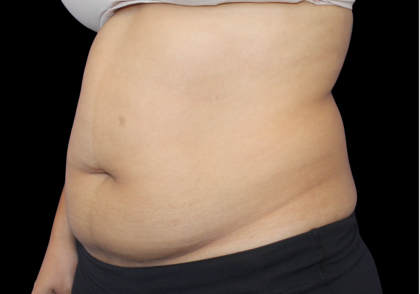 Liposuction Before & After Patient #426