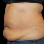 Liposuction Before & After Patient #425