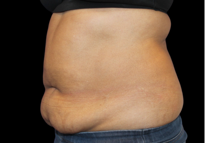 Liposuction Before & After Patient #425