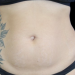 Liposuction Before & After Patient #427