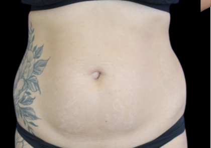 Liposuction Before & After Patient #427
