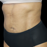 Liposuction Before & After Patient #425