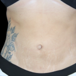 Liposuction Before & After Patient #427