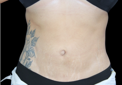 Liposuction Before & After Patient #427