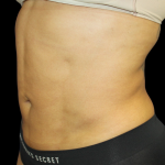 Liposuction Before & After Patient #426