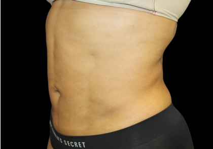 Liposuction Before & After Patient #426