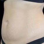 Liposuction Before & After Patient #427