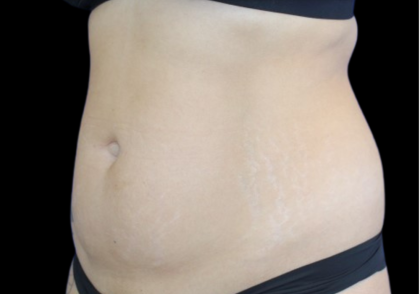 Liposuction Before & After Patient #427