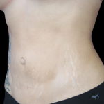 Liposuction Before & After Patient #427