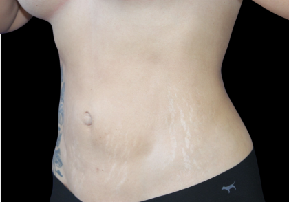 Liposuction Before & After Patient #427