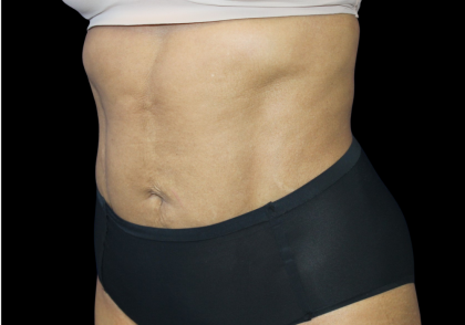 Liposuction Before & After Patient #425