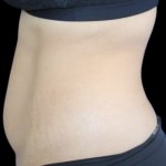 Liposuction Before & After Patient #427