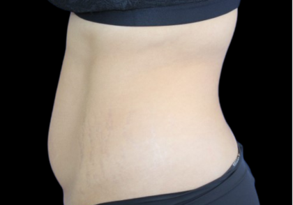 Liposuction Before & After Patient #427