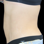 Liposuction Before & After Patient #427