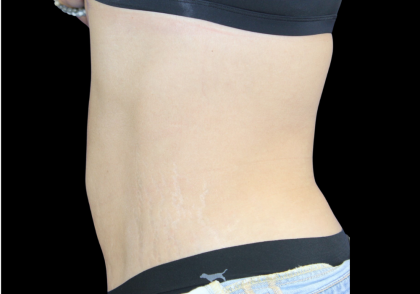 Liposuction Before & After Patient #427